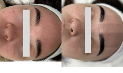 Авторский пилинг Анти-акне 3